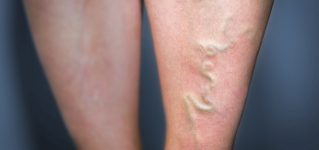 Żylaki nóg – objawy, przyczyny, leczenie