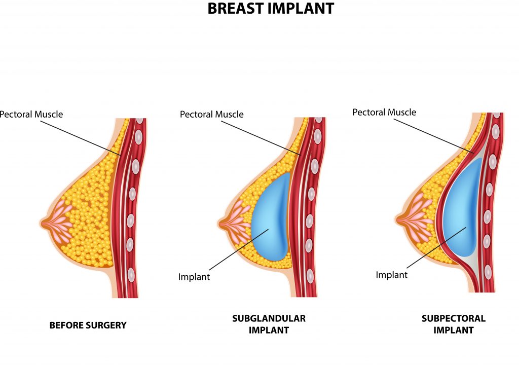 implanty piersi