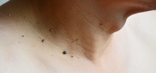 Najczęstsze guzki skóry – charakterystyka i metody leczenia