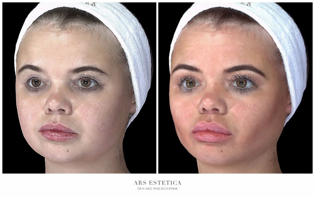 Buccal fat removal Wrocław Ars Estetica