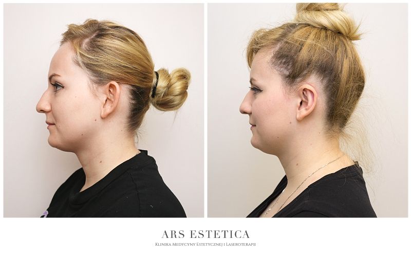 korekta uszu zdjęcia przed i po 2