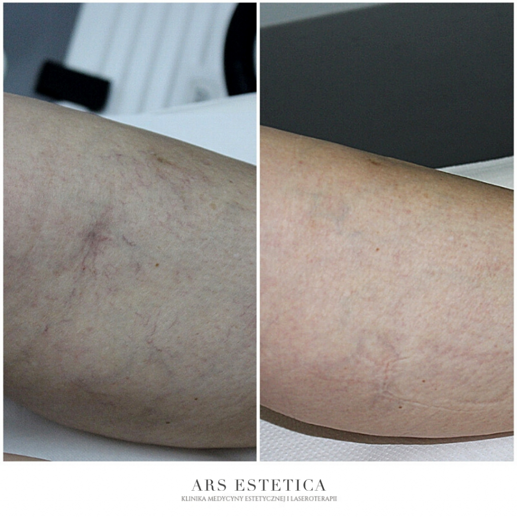 Laserowe zamykanie naczynek Wrocław / Warszawa Ars Estetica