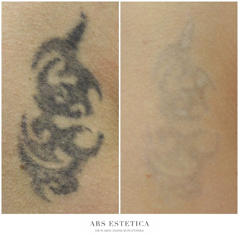 usuwanie tatuażu laserem zdjęcia przed i po