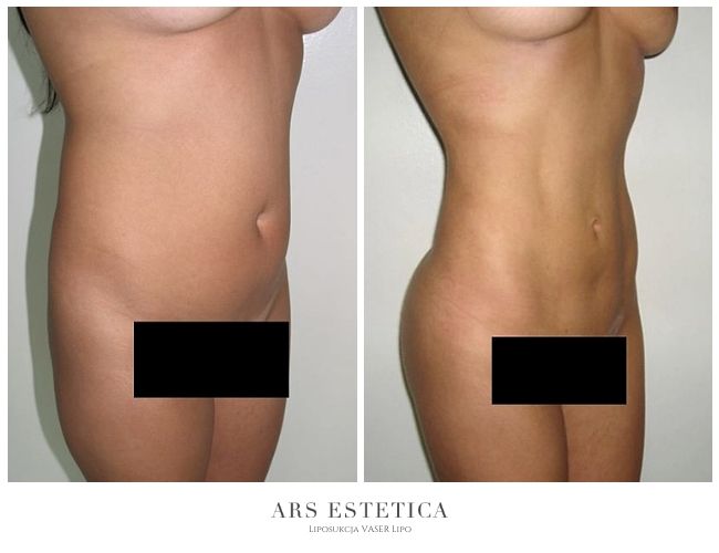 liposukcja zdjęcia przed i po 1