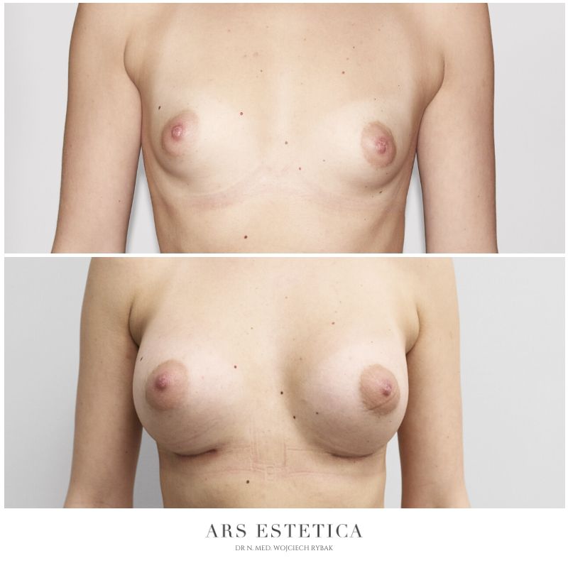 powiększanie piersi zdjęcia przed i po 1