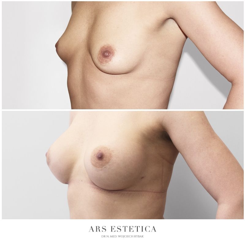 powiększanie piersi zdjęcia przed i po 4