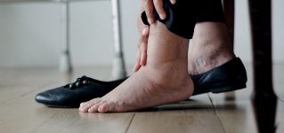 Obrzęki nóg  – dlaczego nogi puchną?