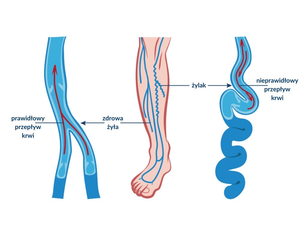 nieprawidłowy przepływ krwi