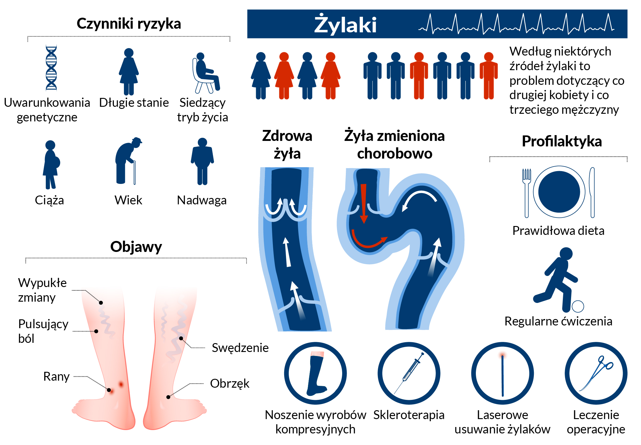 Żylaki infografika 