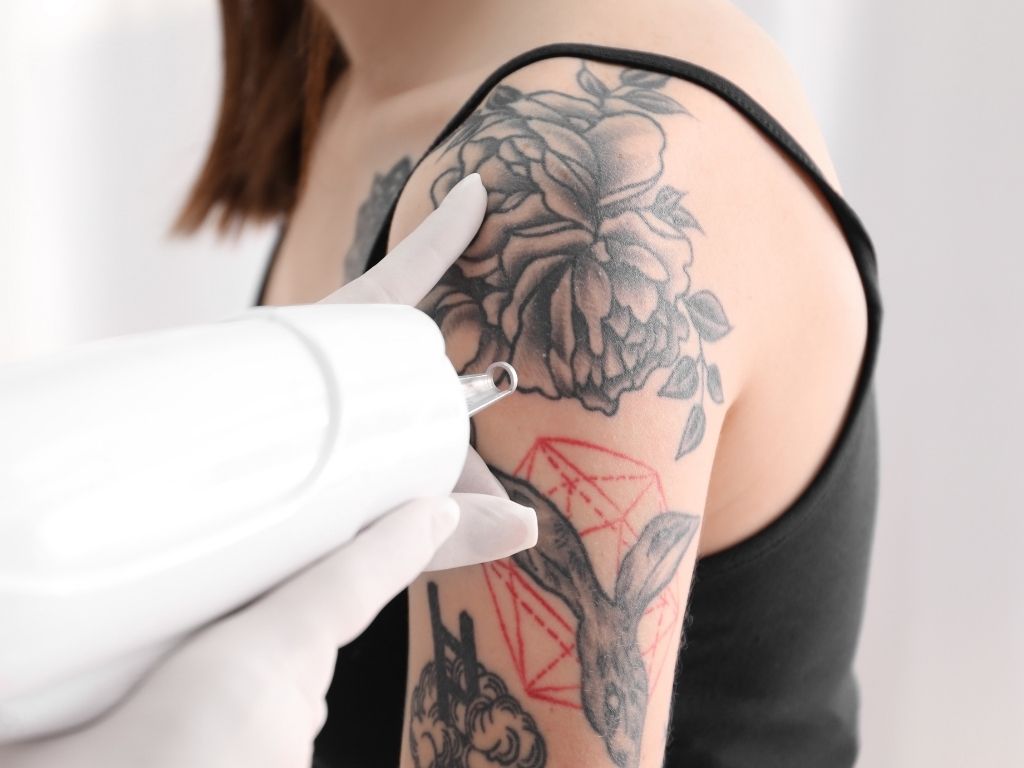 laserowe usuwanie tatuaży