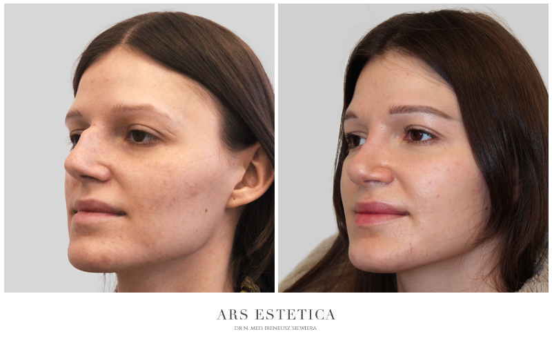 operacja nosa przed i po