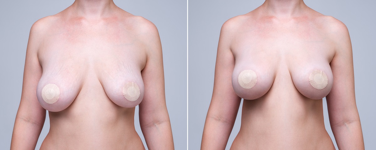 mammoplastyka zmniejszanie piersi