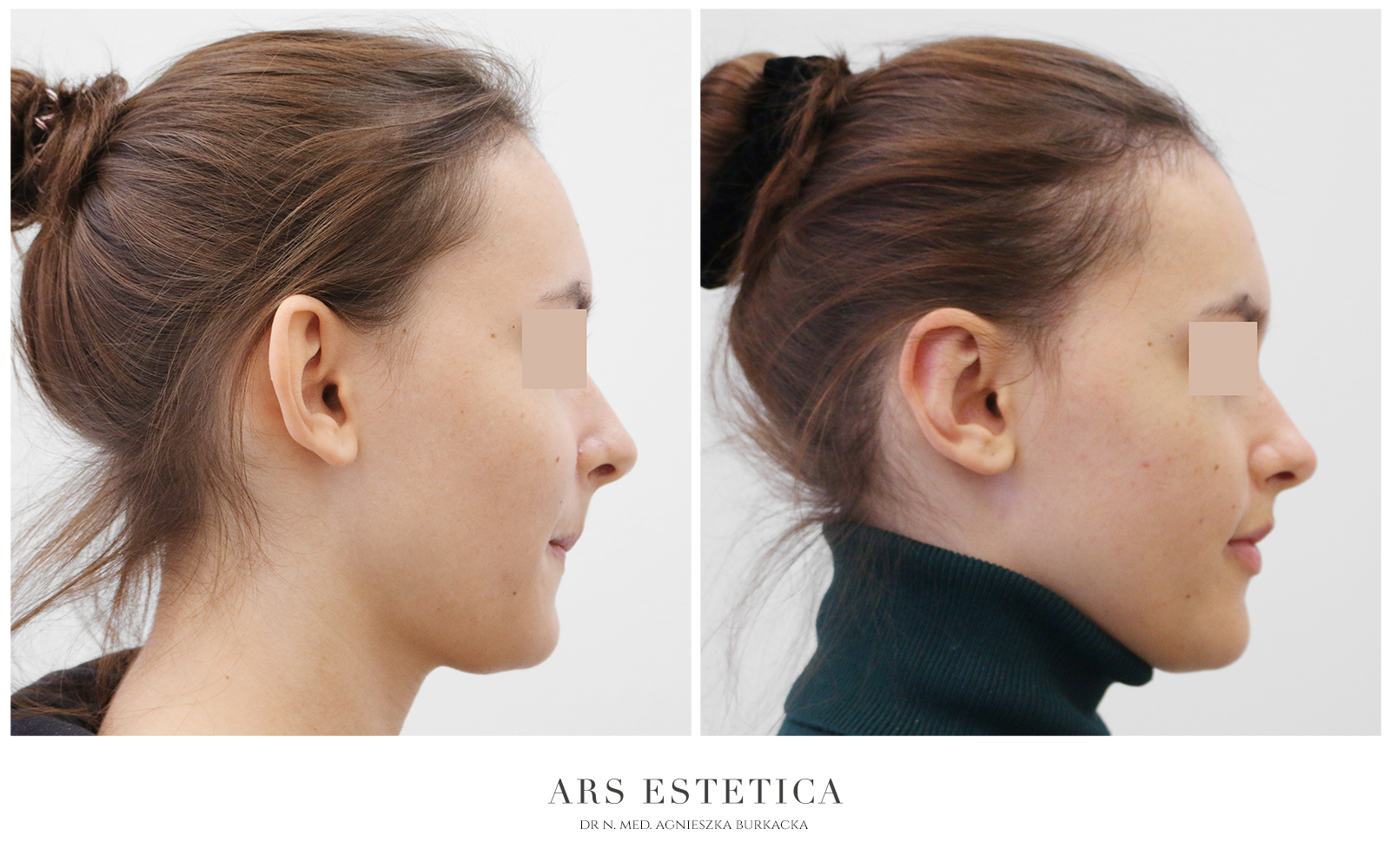 operacja uszu - przed i po
