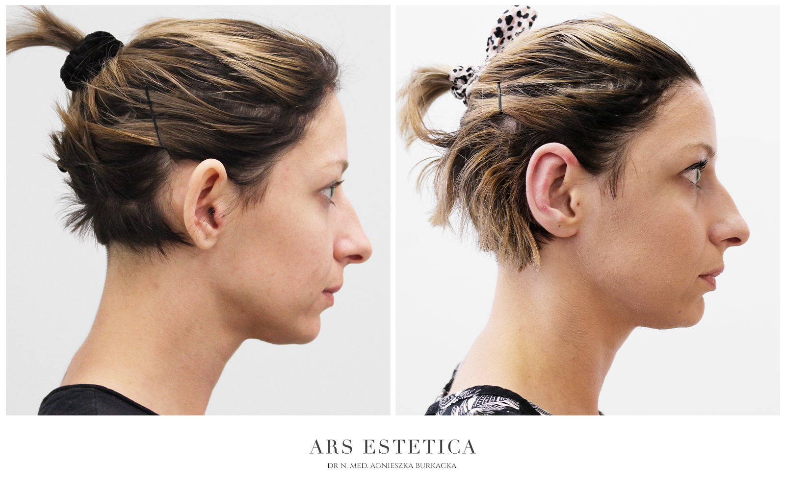 korekcja odstających uszu przed i po