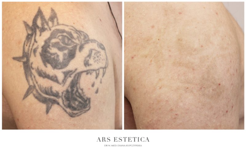 laserowe usuwania tatuazy przed i po