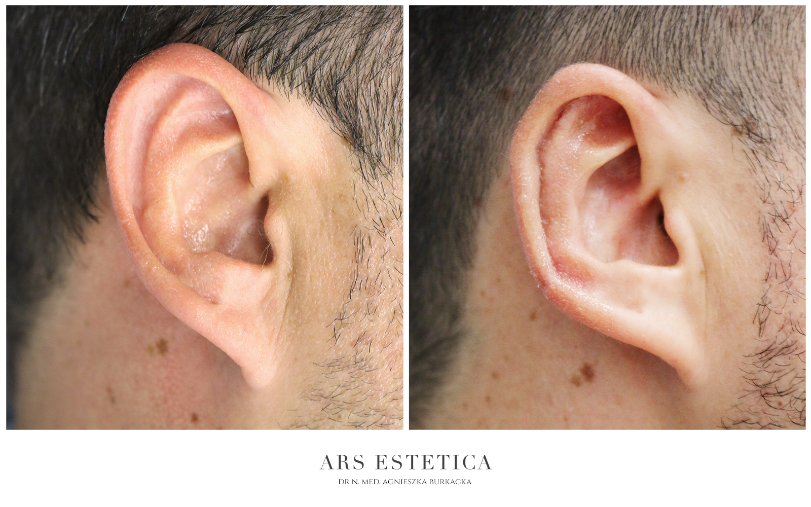 zmniejszenie uszu zdjęcia przed i po