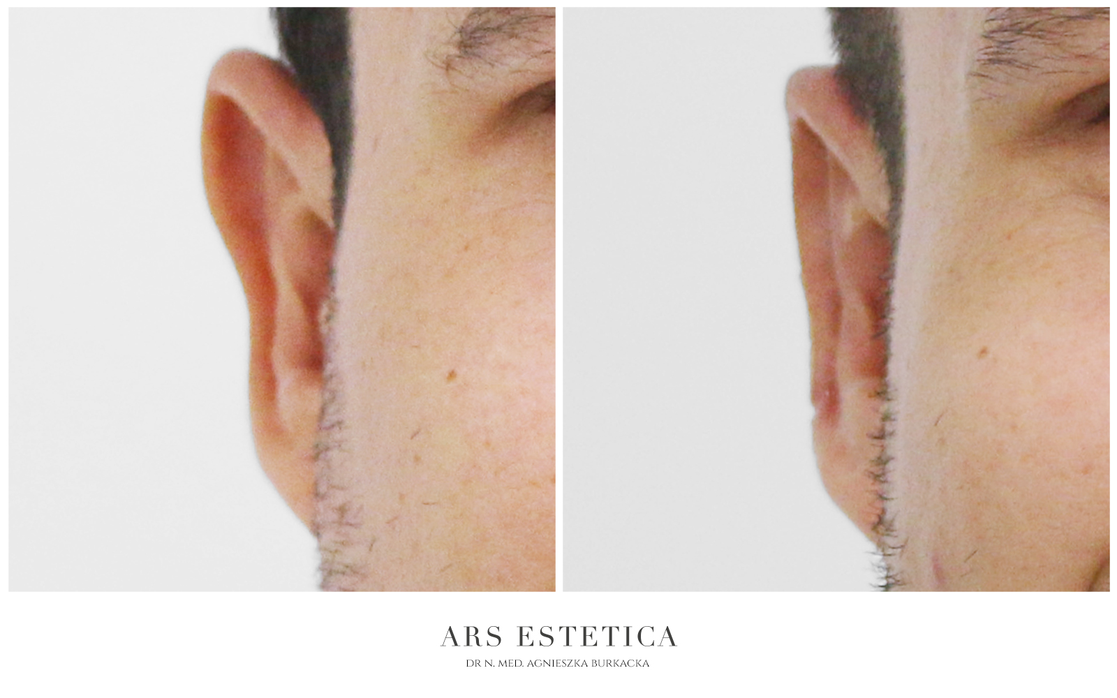 zmniejszenie uszu zdjęcia przed i po