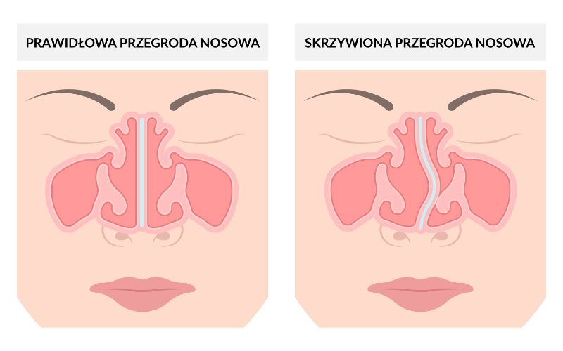 przegroda nosowa skrzywiona i prawidlowa