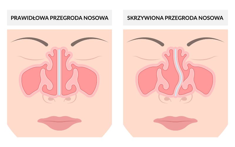 przegroda nosowa skrzywiona i prawidlowa