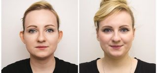 Korekcja uszu – zdjęcia przed i po