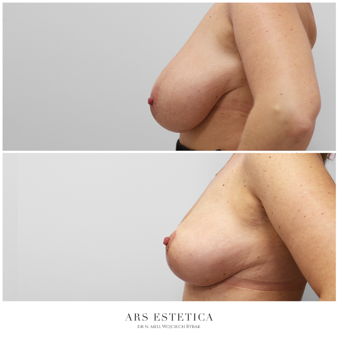 mammoplastyka i mastopeksja zdjęcia