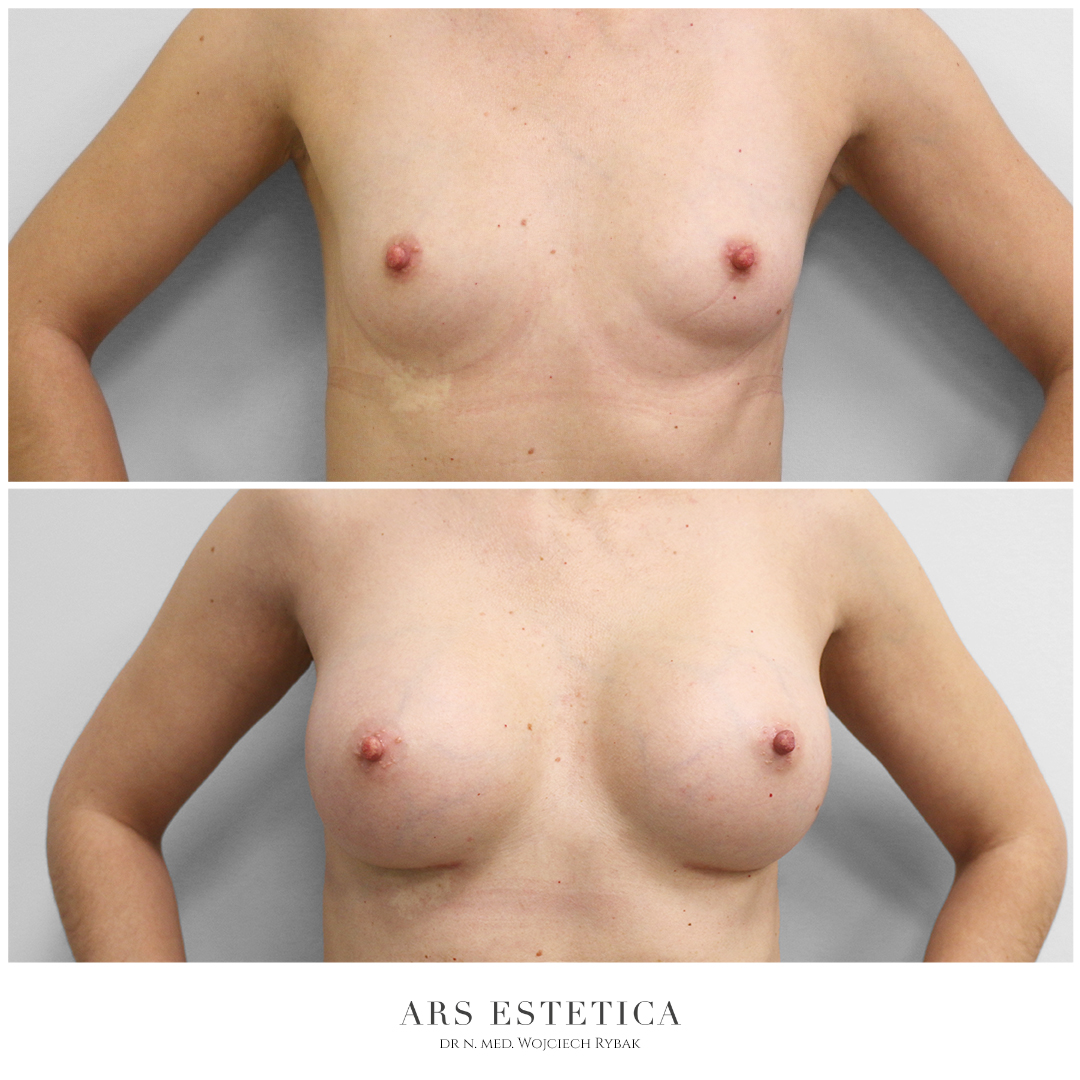 powiększanie piersi efekt zdjęcia przed i po