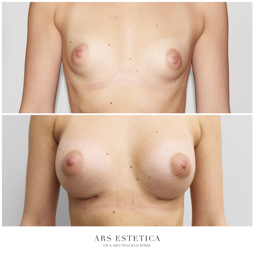 powiększanie piersi implantami anatomicznymi przed i po 