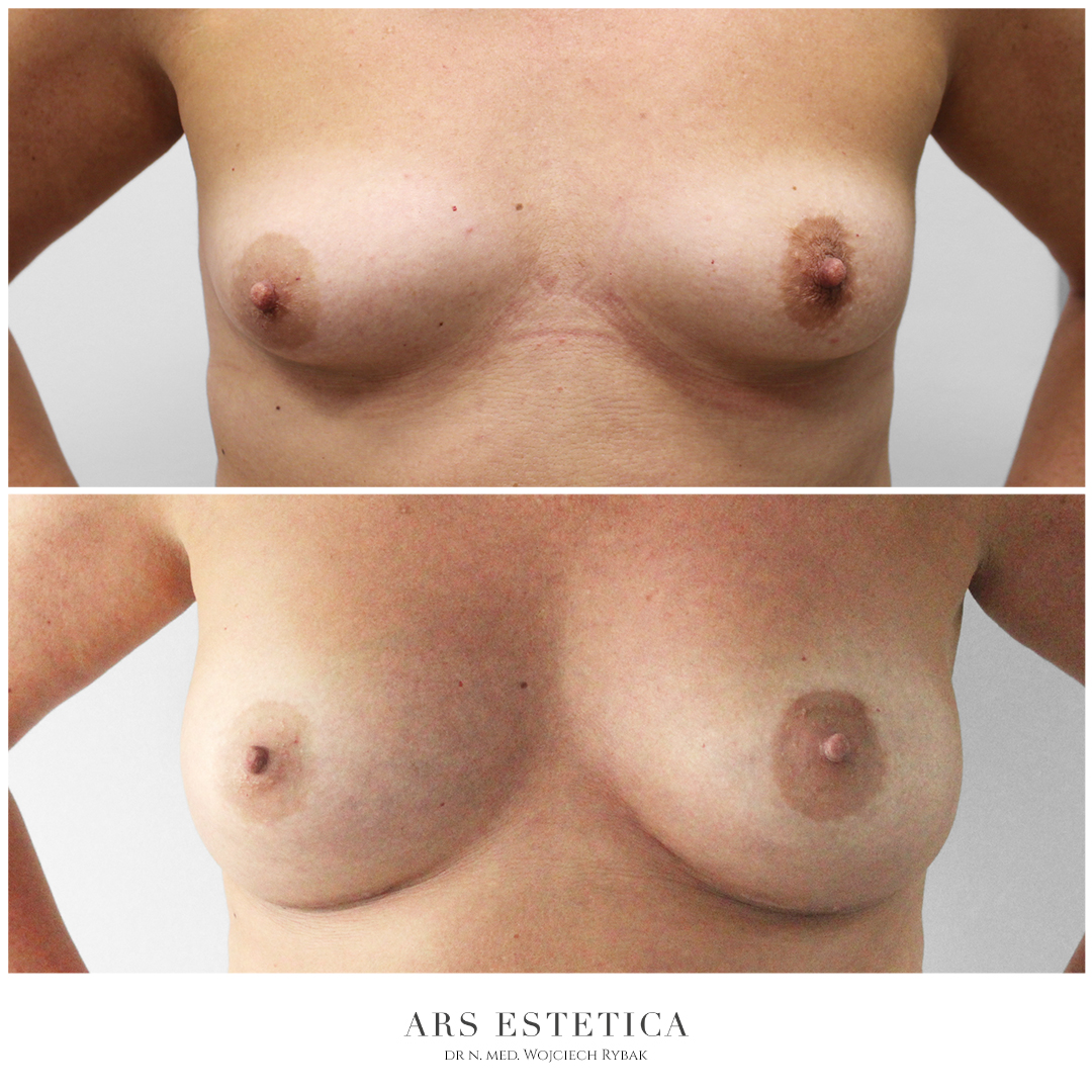 powiększanie piersi zdjęcia przed i po operacji