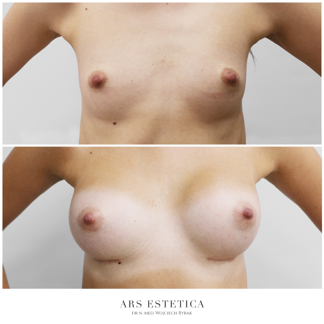 powiększanie piersi zdjęcia przed i po zabiegu