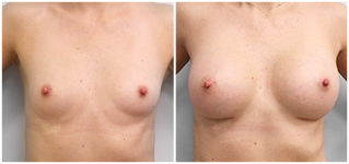 Powiększanie piersi – zdjęcia przed i po