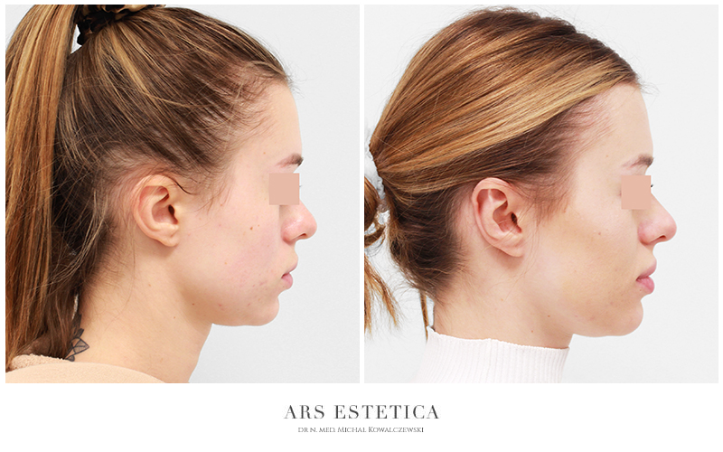 korekcja uszu zdjęcia przed i po