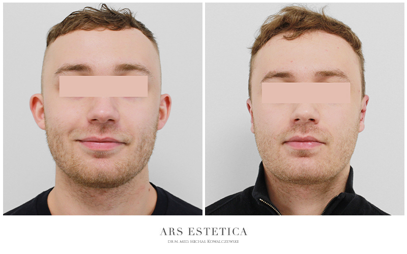 operacja uszu przed i po