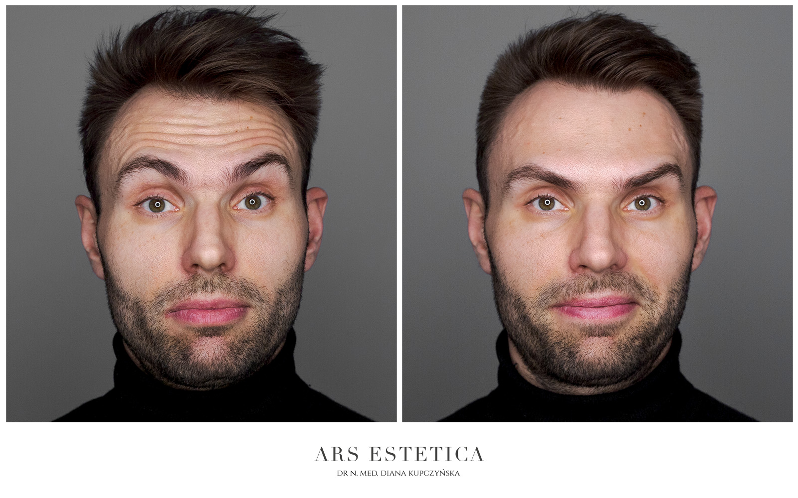 botox zdjęcia przed i po