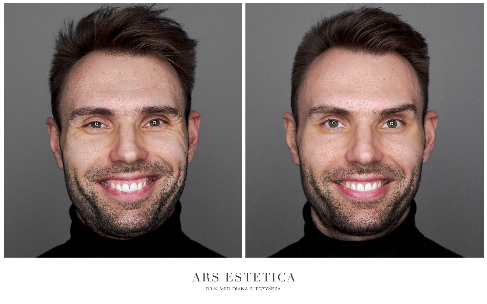 botox zdjęcia przed i po