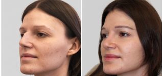 Korekcja nosa – zdjęcia przed i po (galeria)