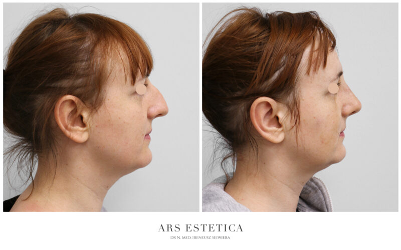 osteotomia nosa przed i po