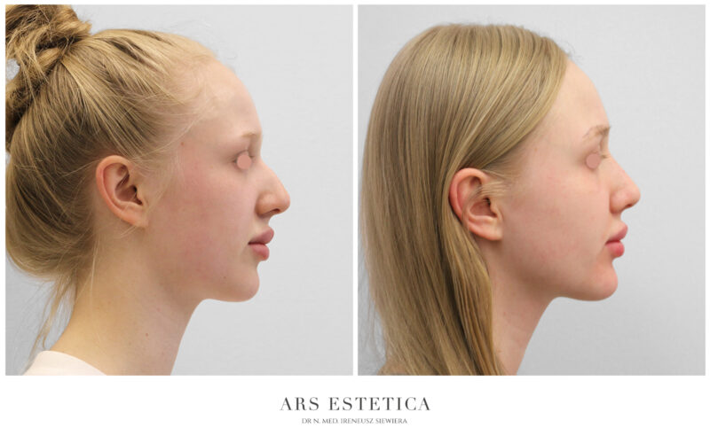 korekcja garbatego nosa przed i po