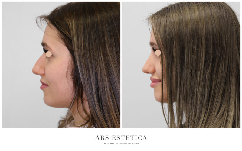 operacja nosa zdjęcia przed i po