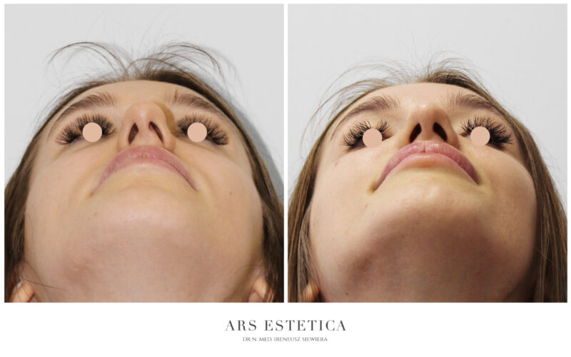 operacja nosa zdjęcia przed i po