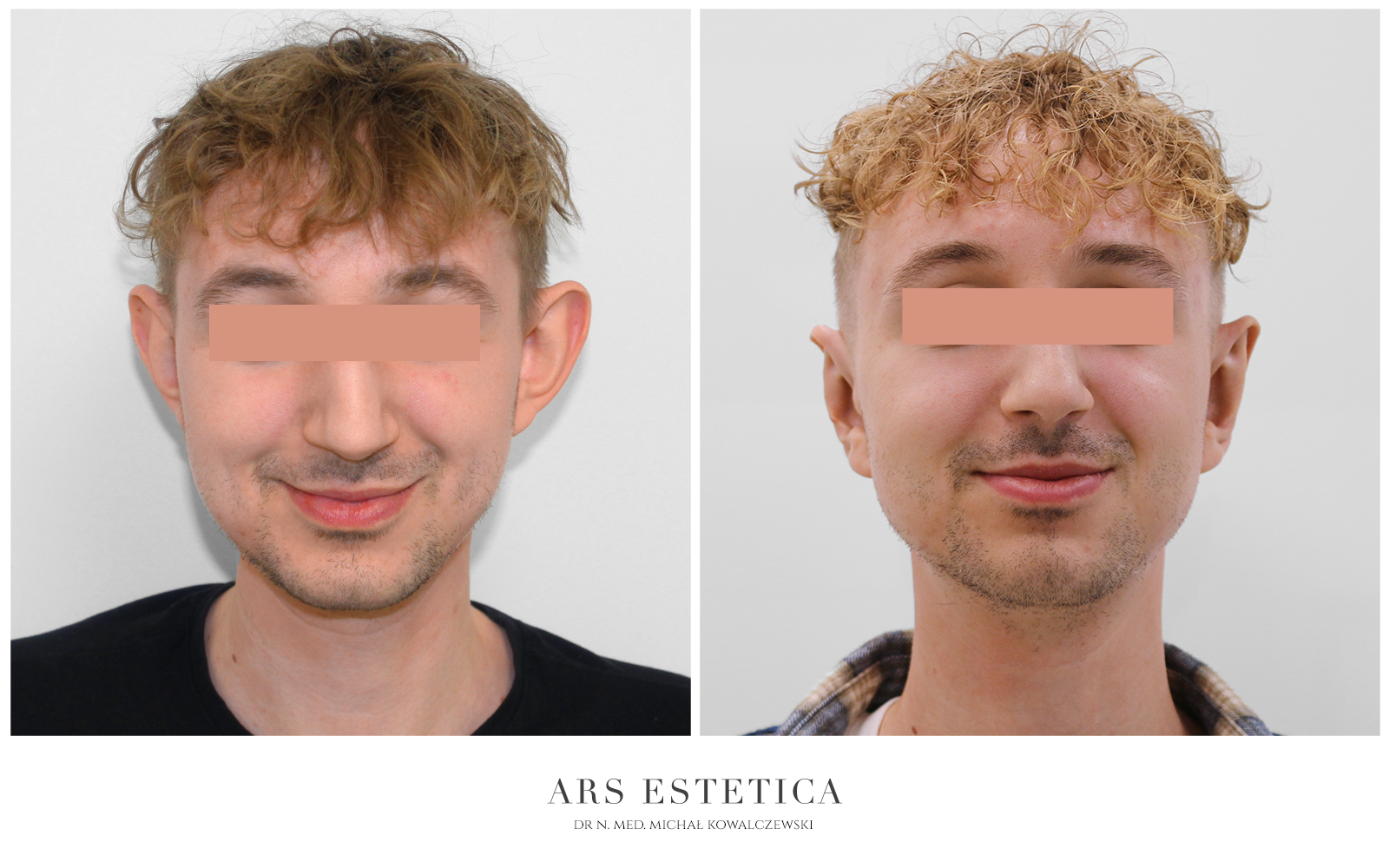 operacja odstających uszu zdjęcia przed i po