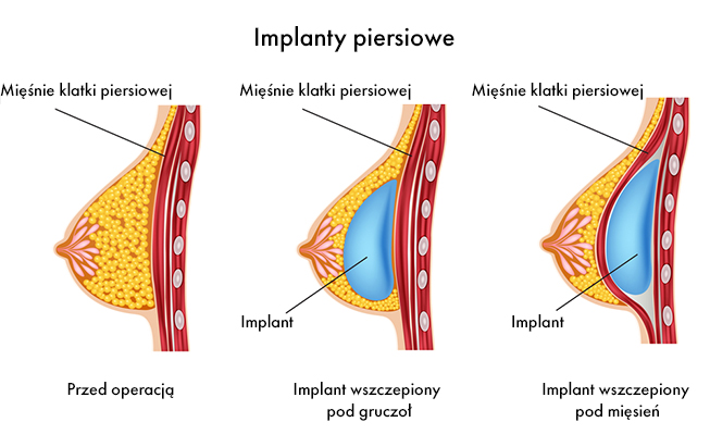 implanty piersiowe anatomiczne 