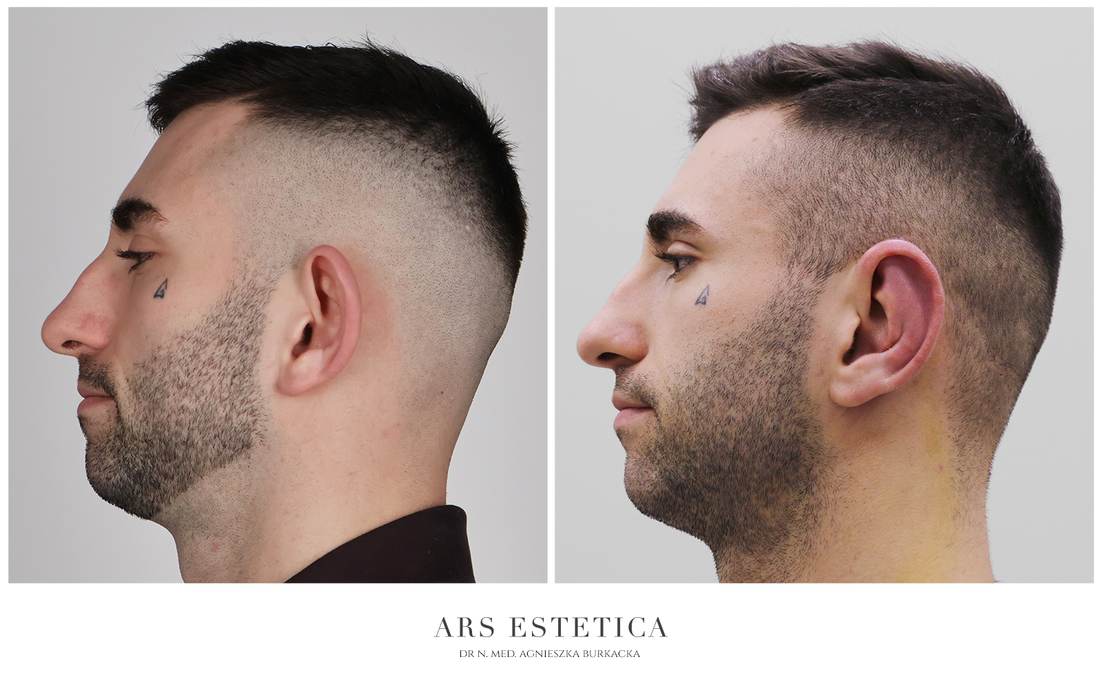 korekta uszu profil przed i po