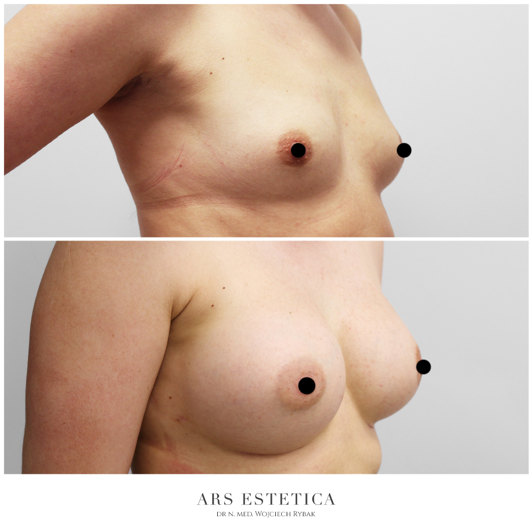 powiększanie piersi zdjęcia przed i po (1)