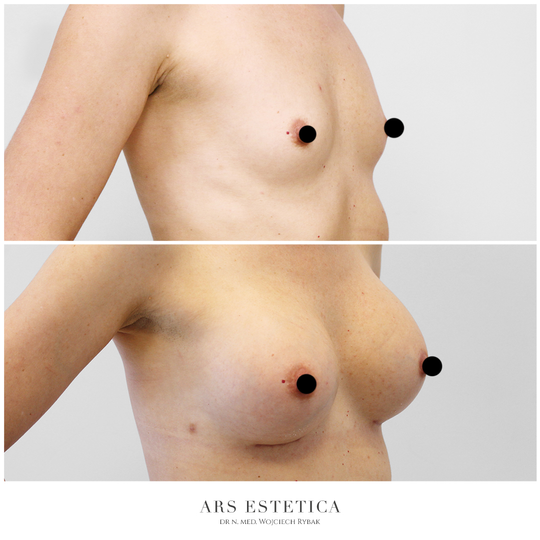 powiększanie piersi zdjęcia przed i po (2)