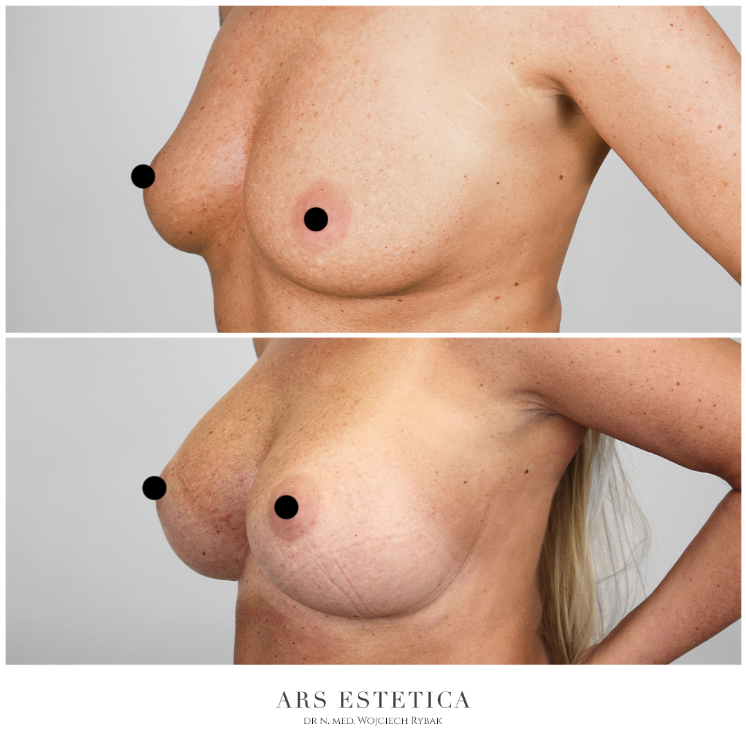 powiększanie piersi zdjęcia przed i po (4)