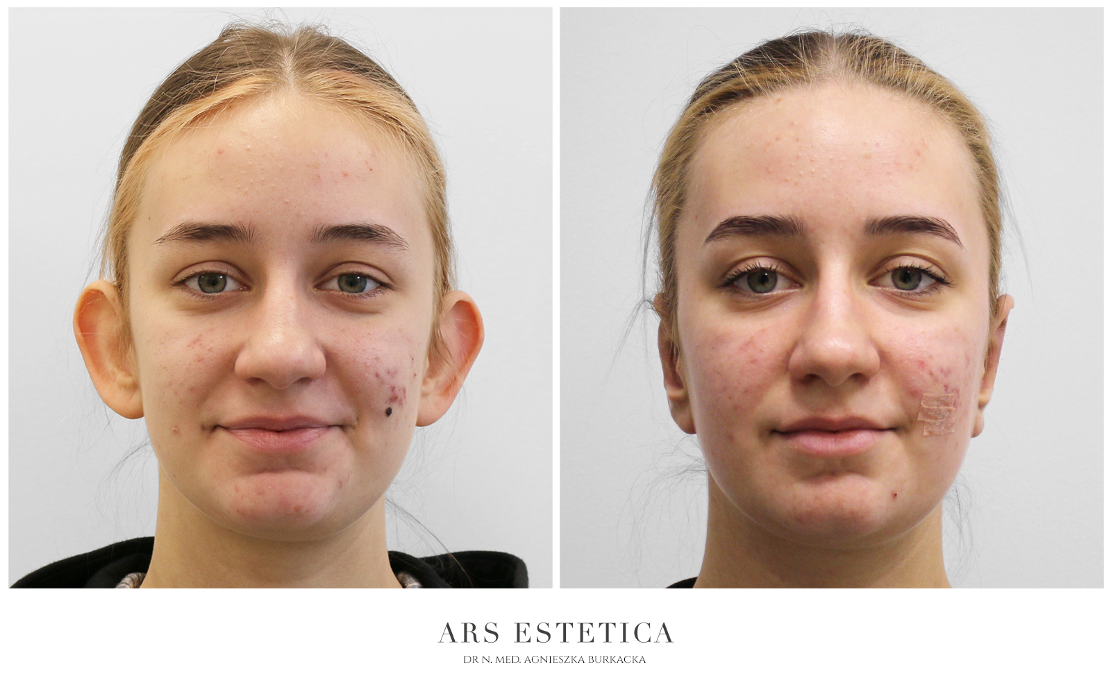 korekta uszu zdjęcia przed i po