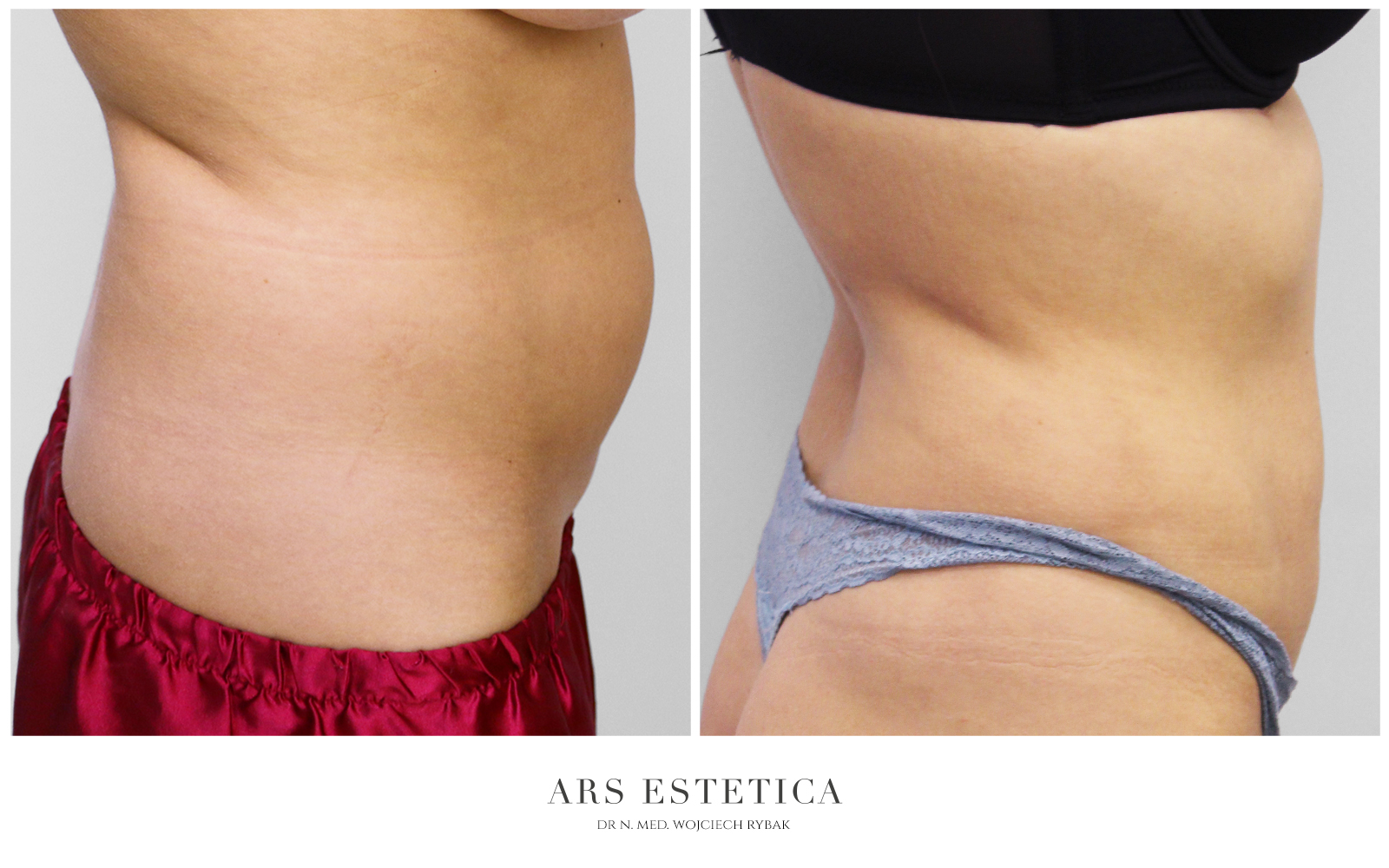 liposukcja ultradźwiękowa efekty