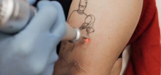 Pielęgnacja skóry po laserowym usuwaniu tatuażu
