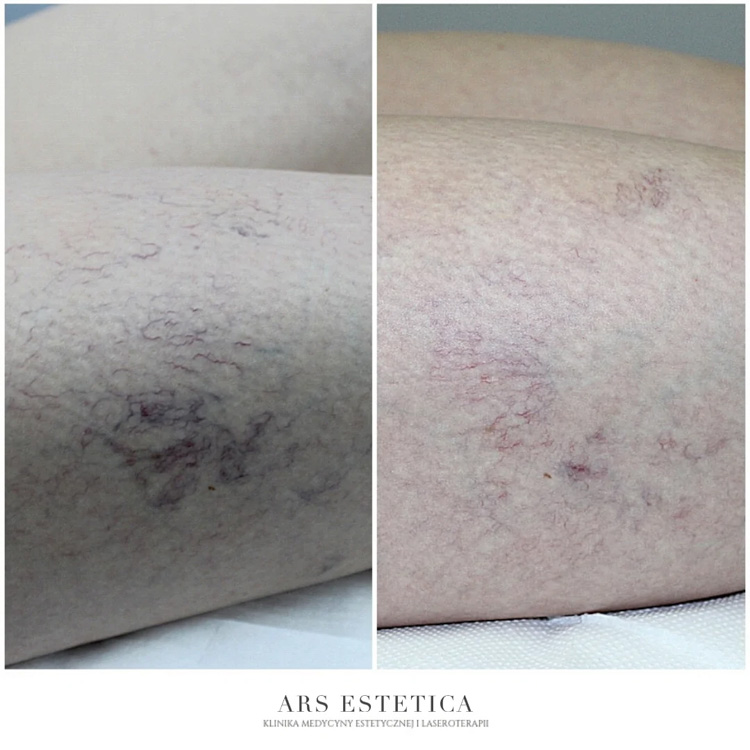laser i skleroterapia