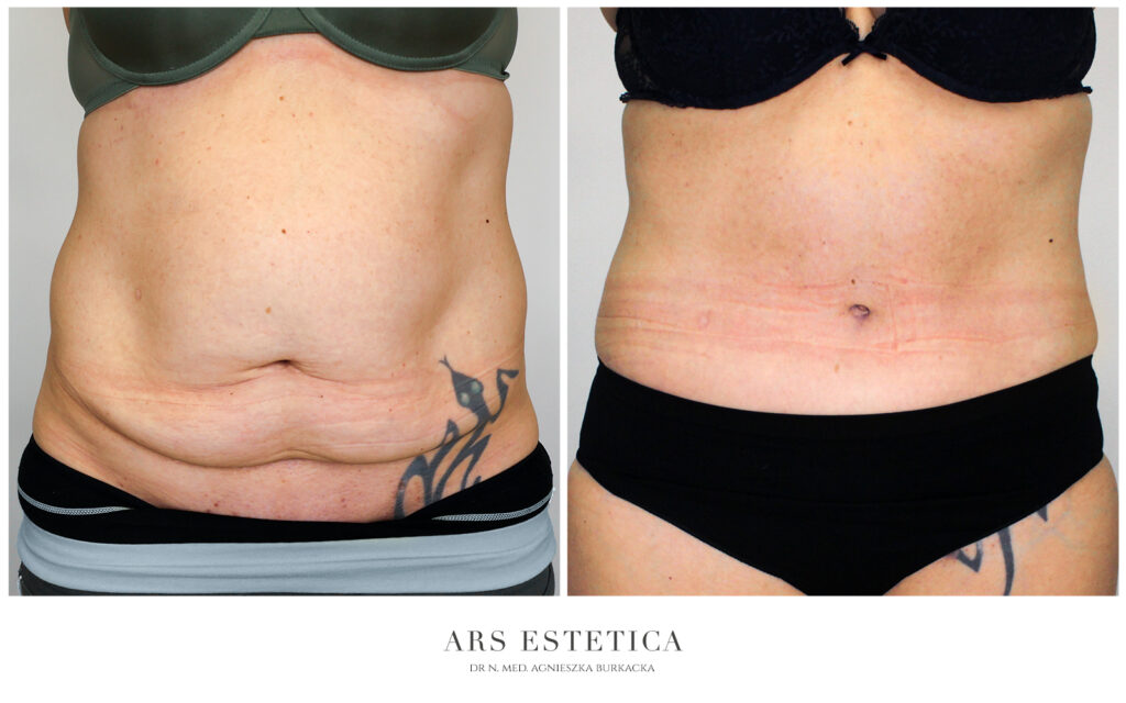 abdominoplastyka z liposukcją przed i po